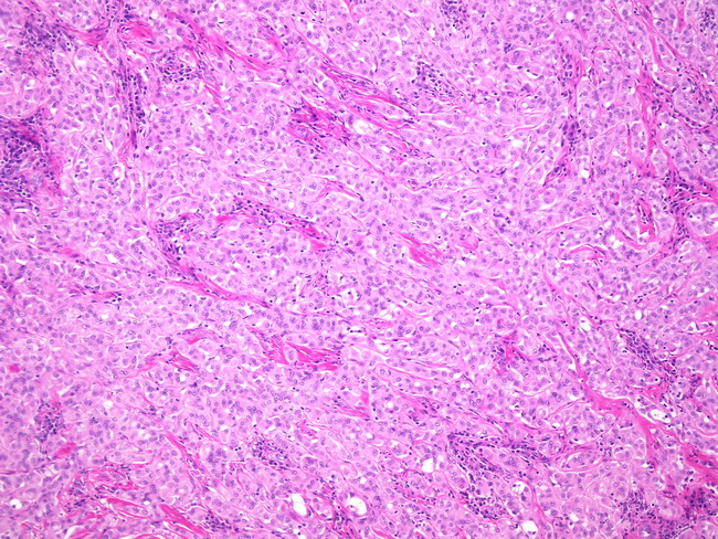 Adenomatoid Tumor2.jpg